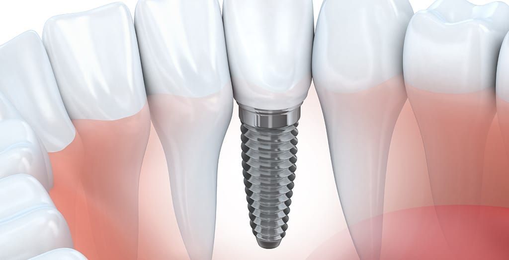 A close up of a tooth with a dental implant in it.