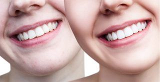 A before and after picture of a woman 's teeth.