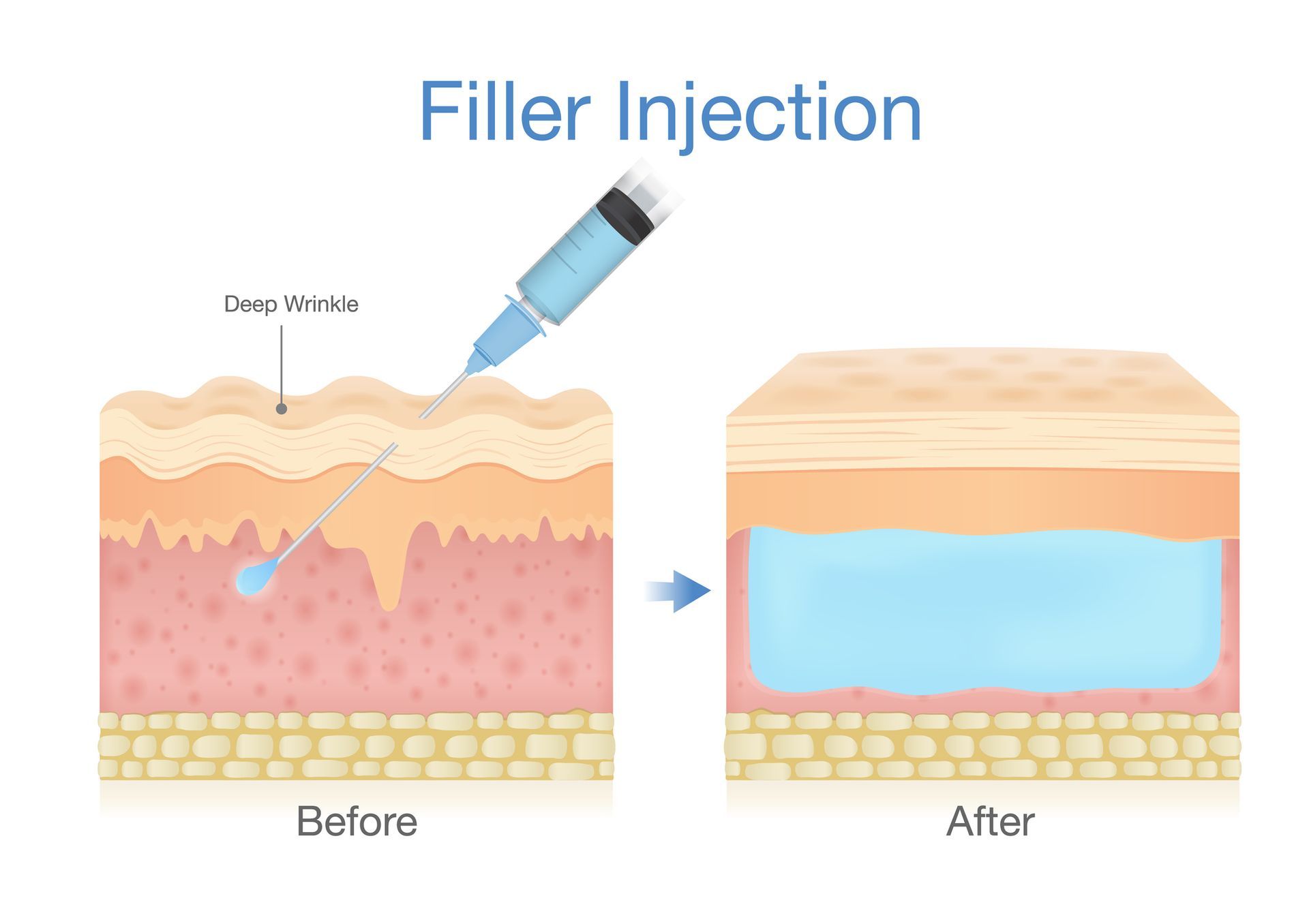 A before and after picture of a filler injection in the skin.