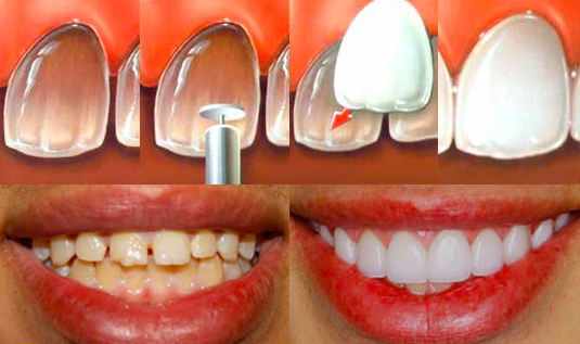 implantologia e sbiancamento dentale