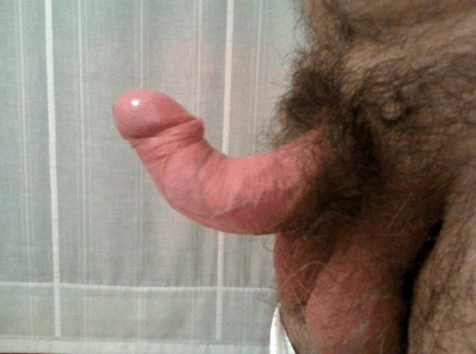 induratio penis plastica