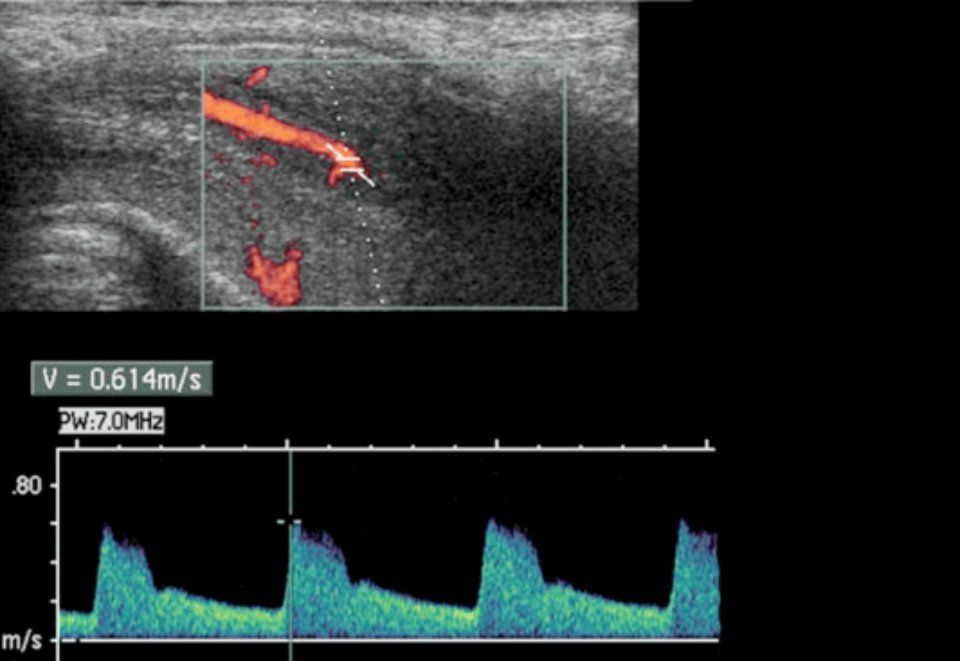 disfunzione erettile