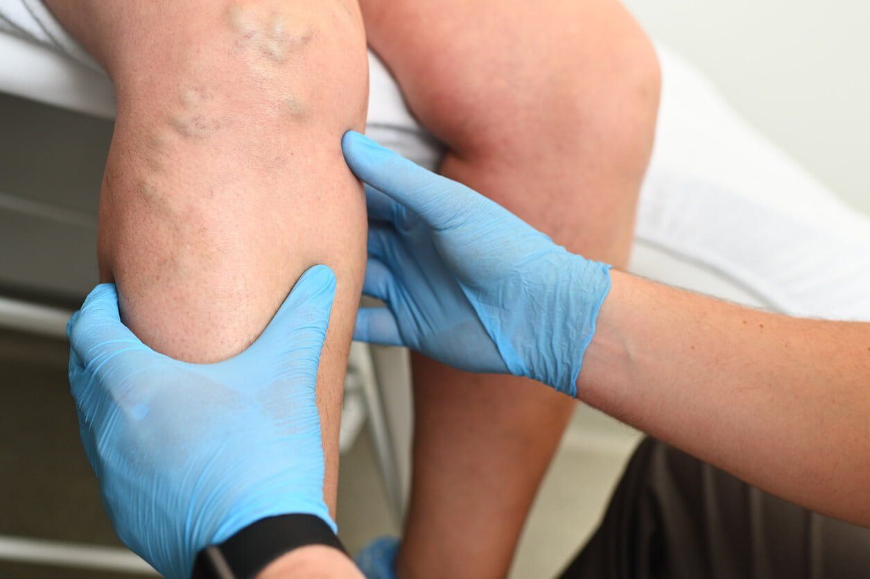 A doctor is examining a patient 's leg with varicose veins.