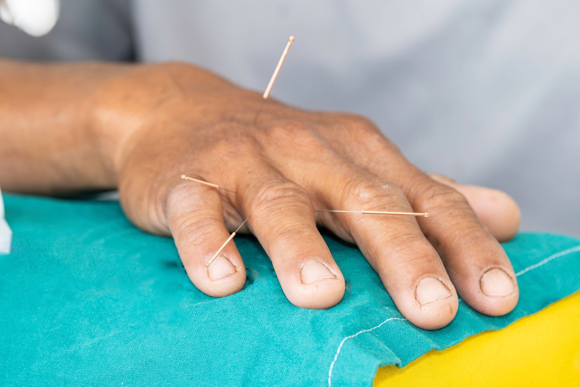 A person is getting acupuncture on their hand.