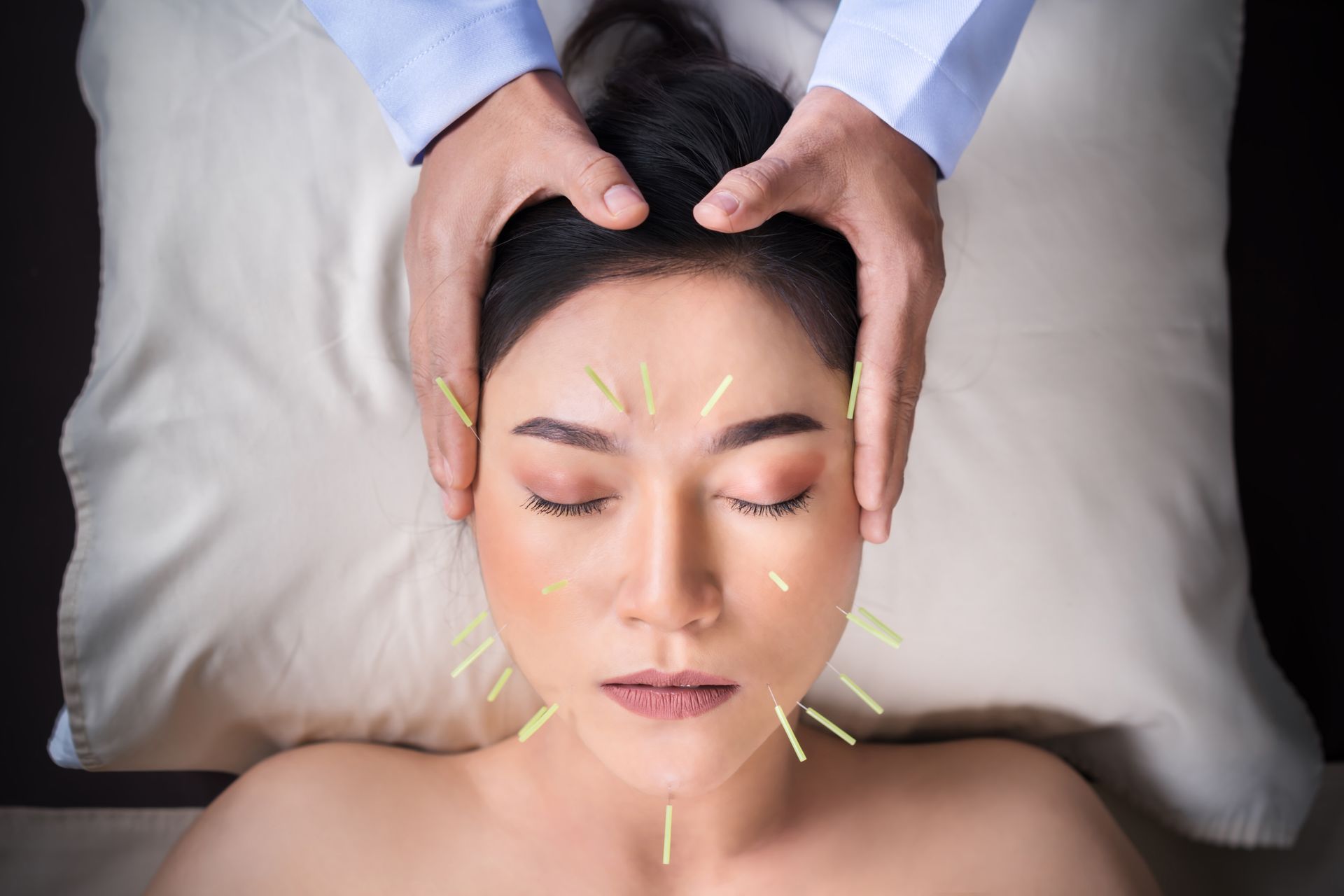 A woman is getting acupuncture on her face.