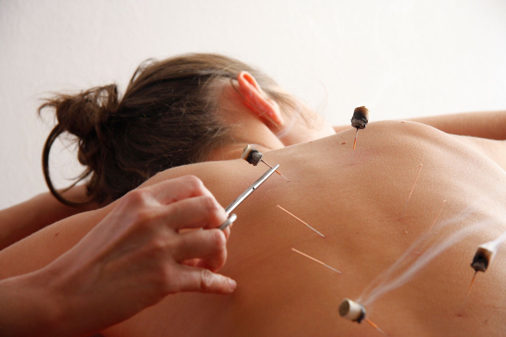 A woman is getting acupuncture on her back.