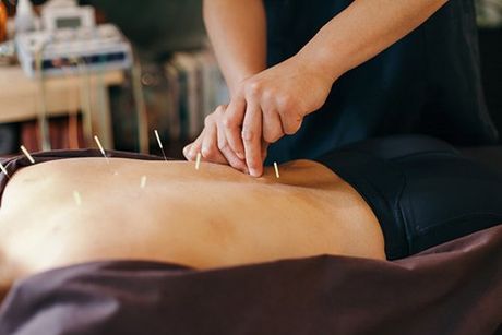 Acupuncture — Therapist Inserting Needles in Dyer, IN