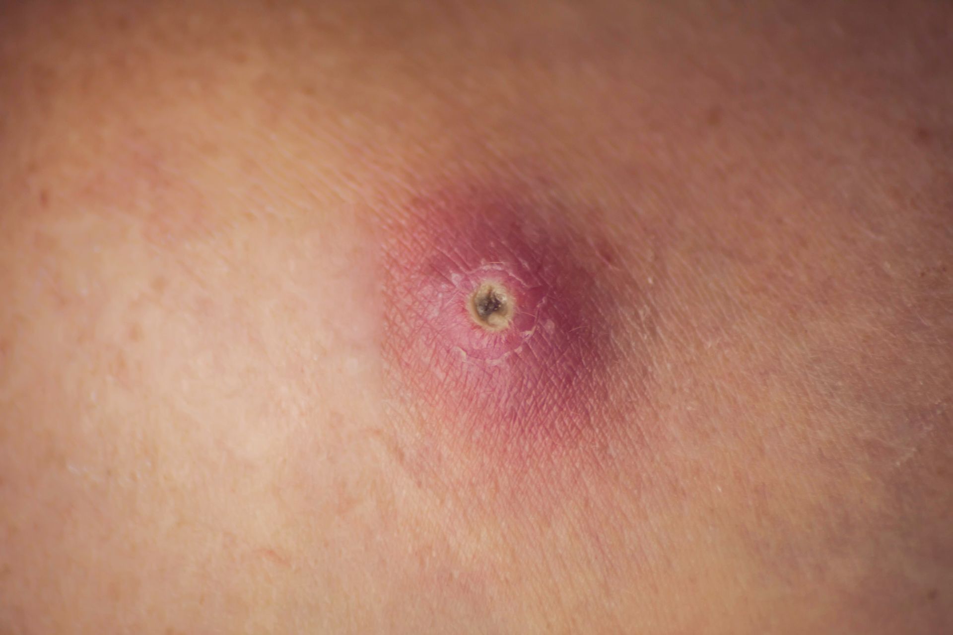 Infecções de pele (Furúnculo e Erisipela/Celulite)