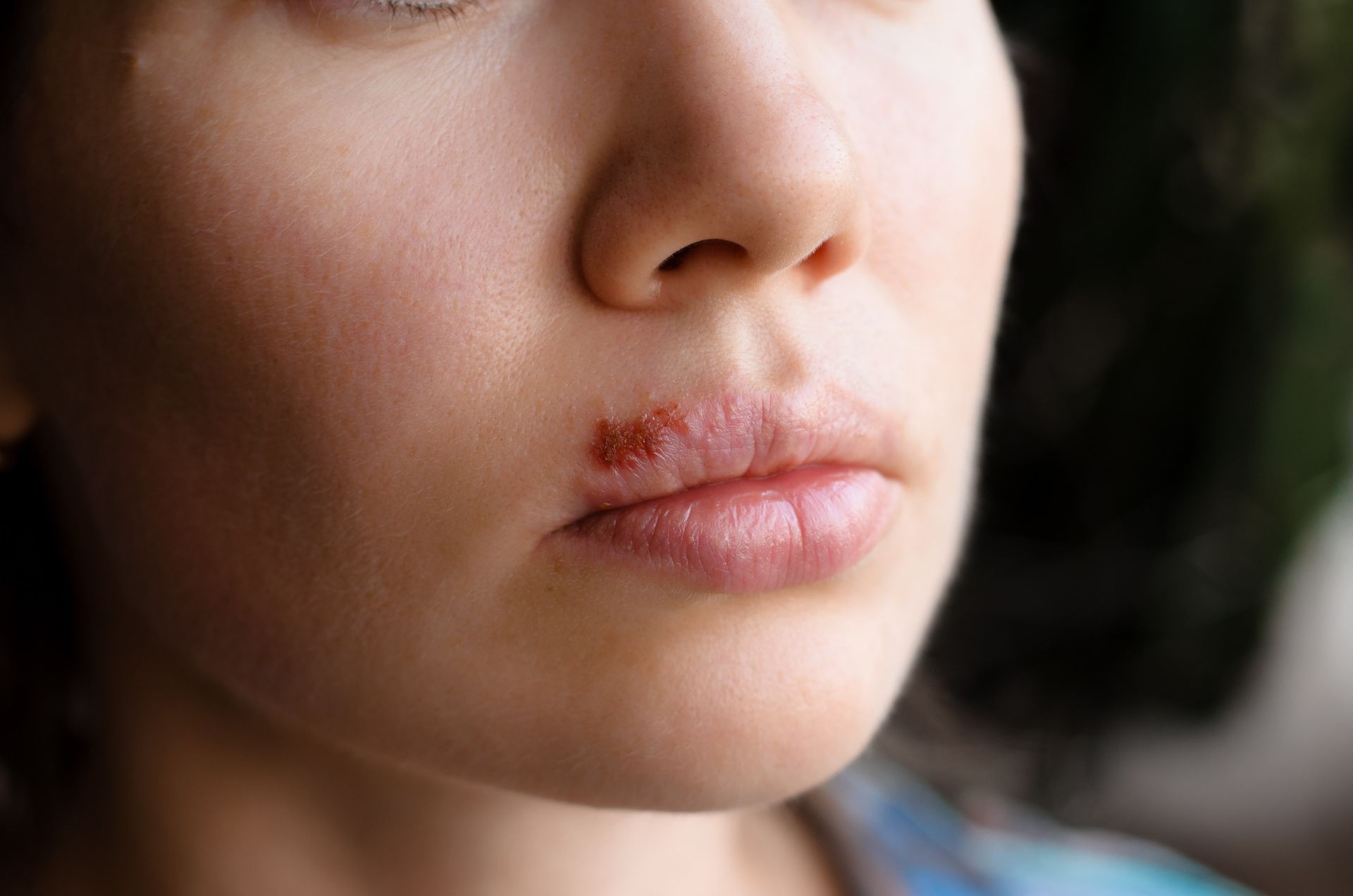 Herpes simples e Herpes Zoster