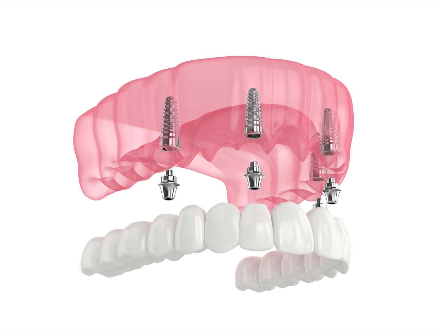 All-on-4 Dental Implants