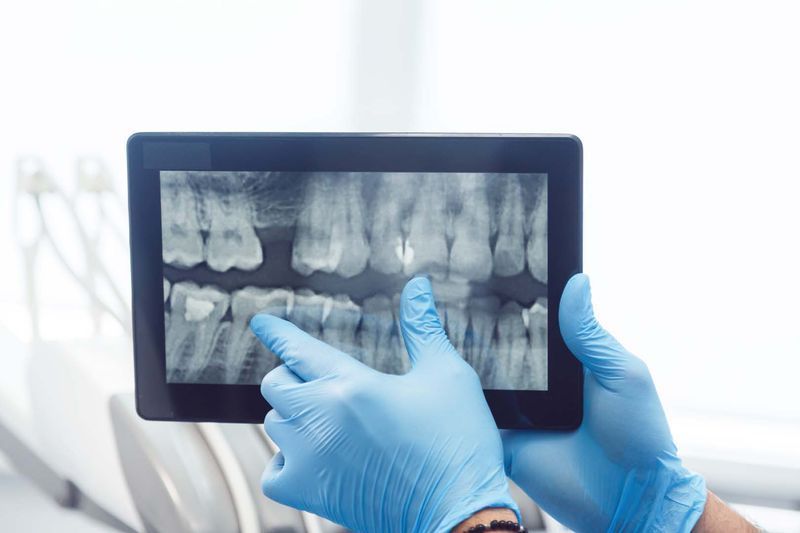 Dental X-Rays