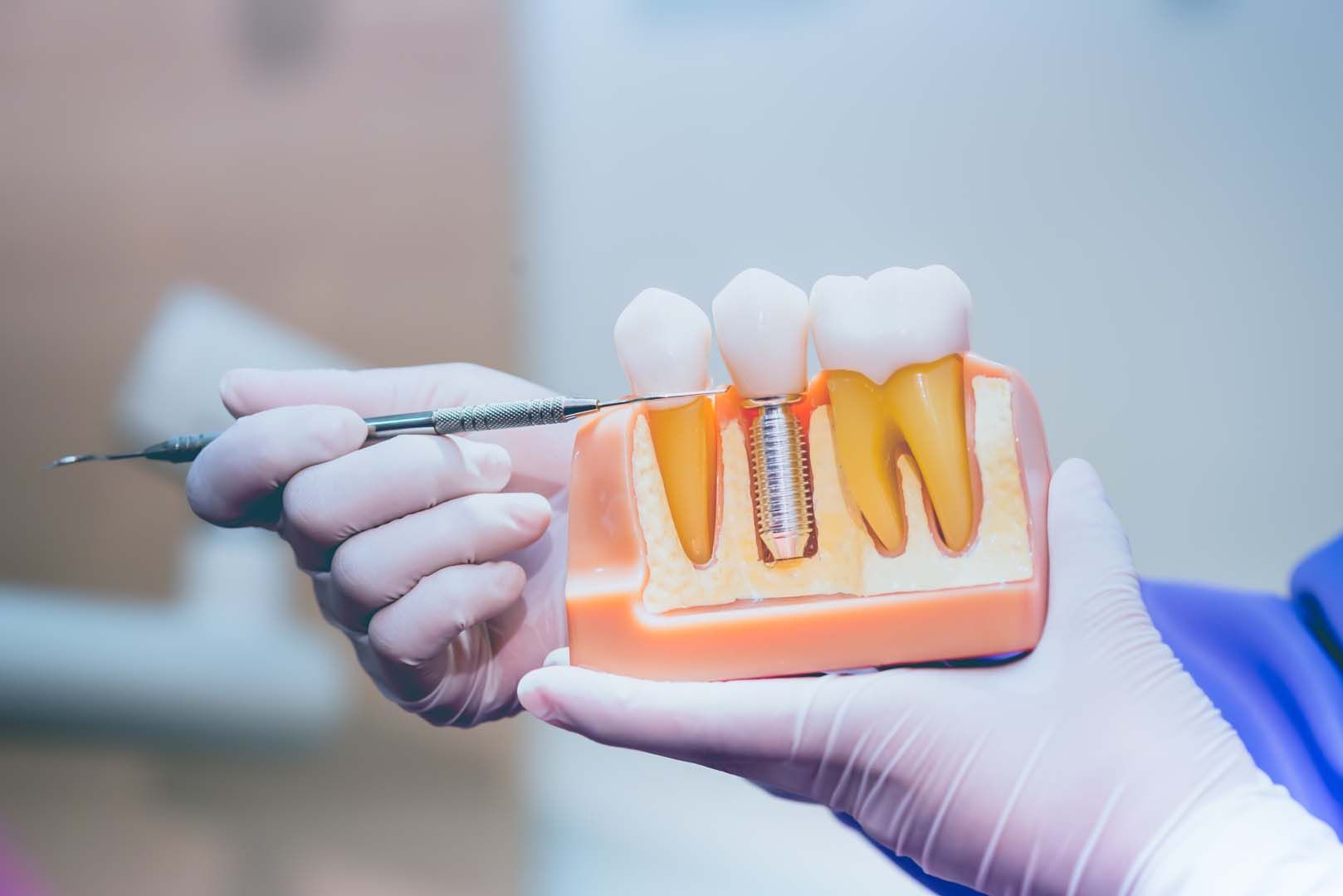 How Often Do Dental Implants Need to be Replaced?