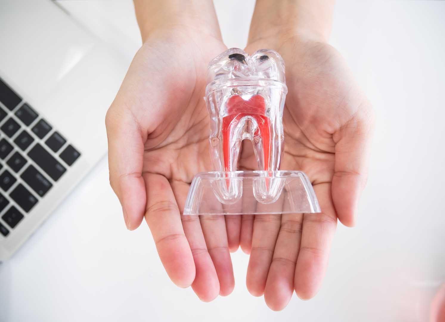 Root Canals