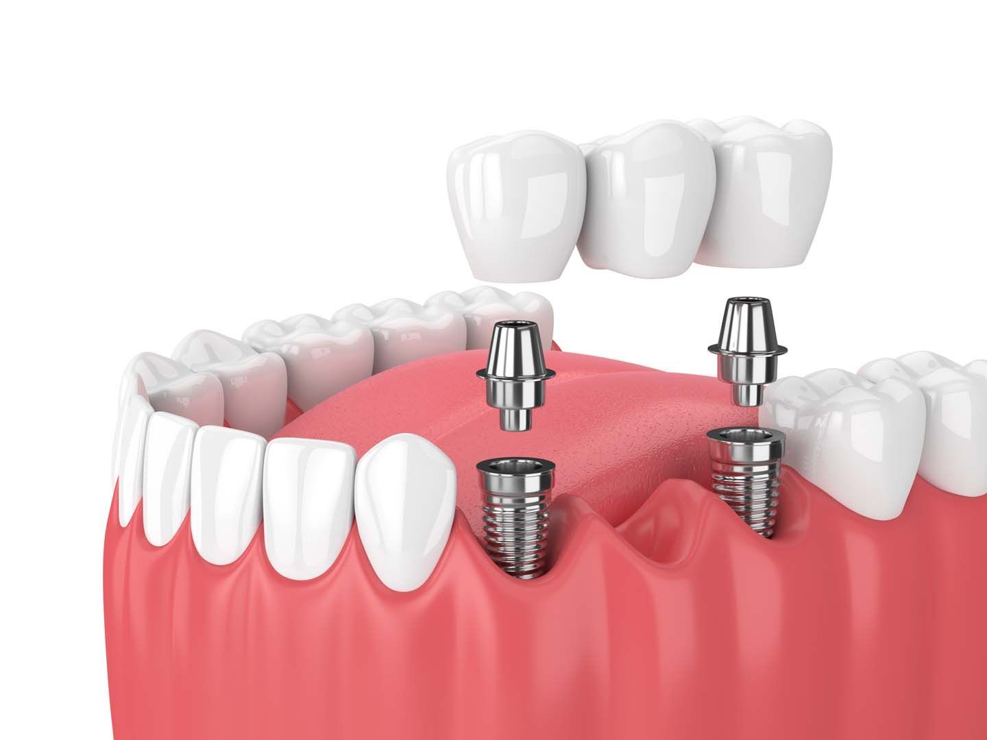 What Are the Pros and Cons of Dental Crowns?