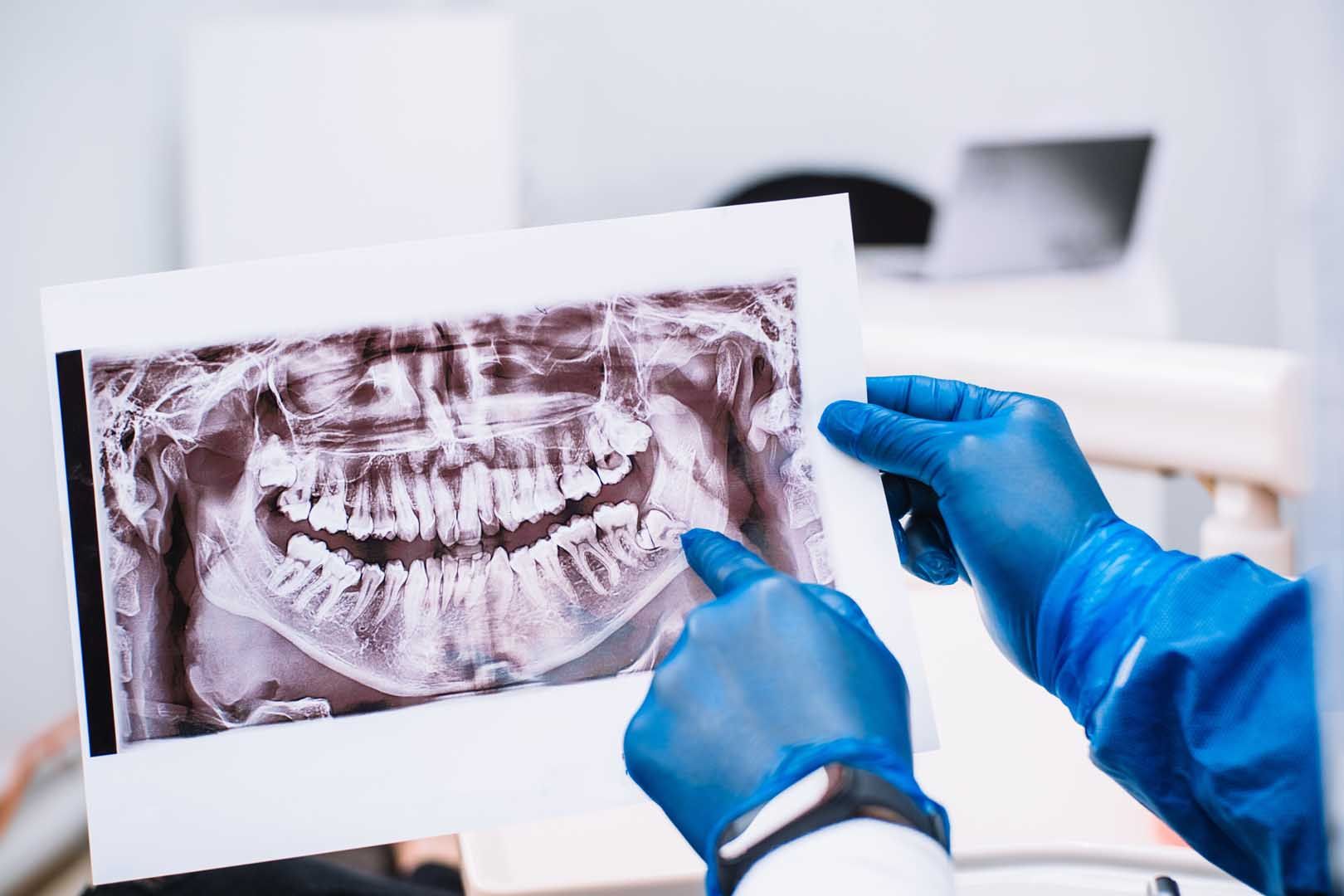 Wisdom Teeth Removal
