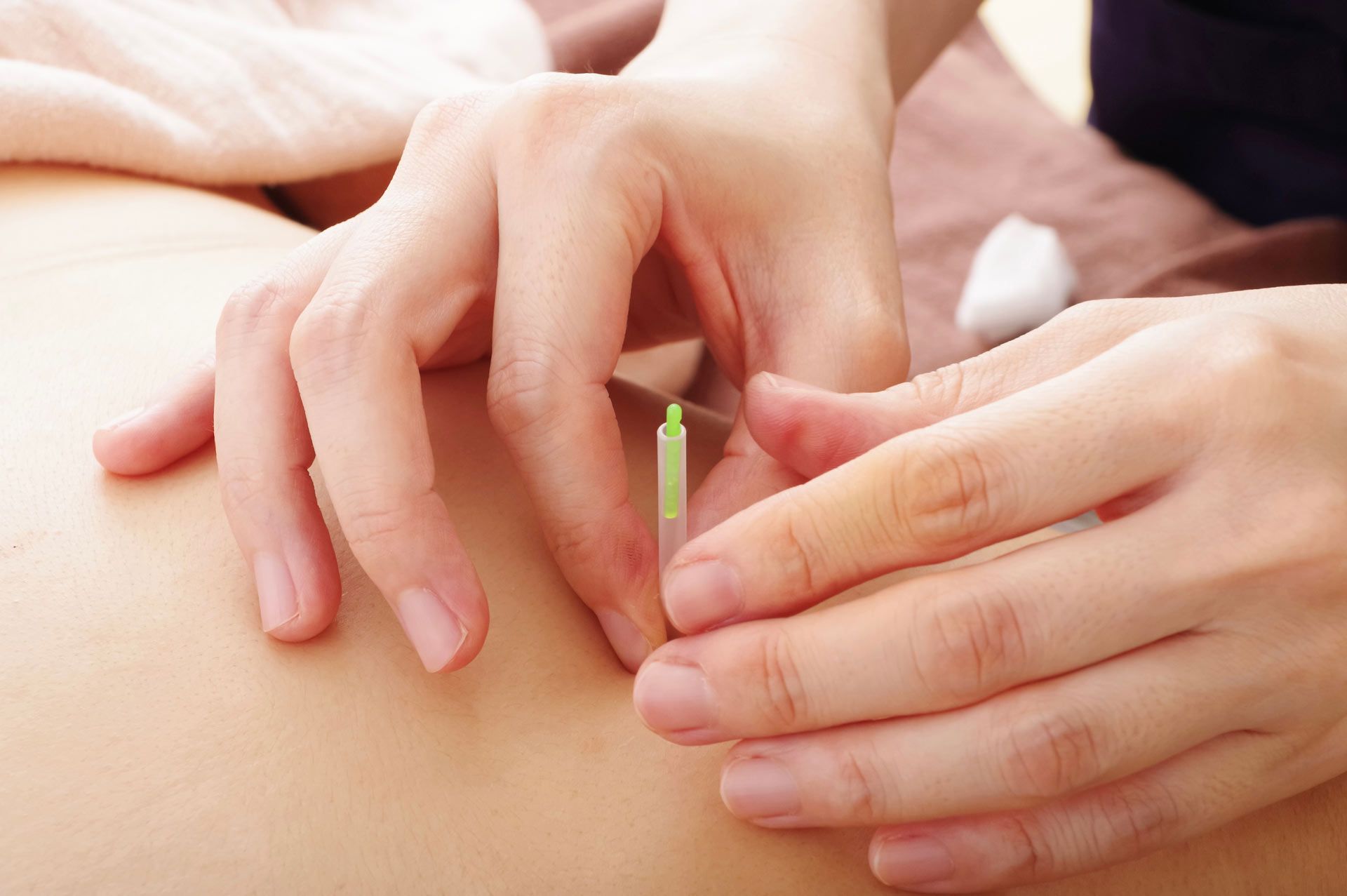 A person is getting acupuncture on their back.