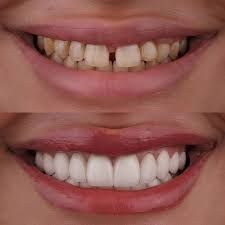 Before and after view of a smile, showing teeth before and after cosmetic dental work. Before and after view of a smile, showing teeth before and after cosmetic dental work.