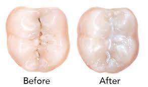 Comparison of two teeth: Comparison of two teeth: