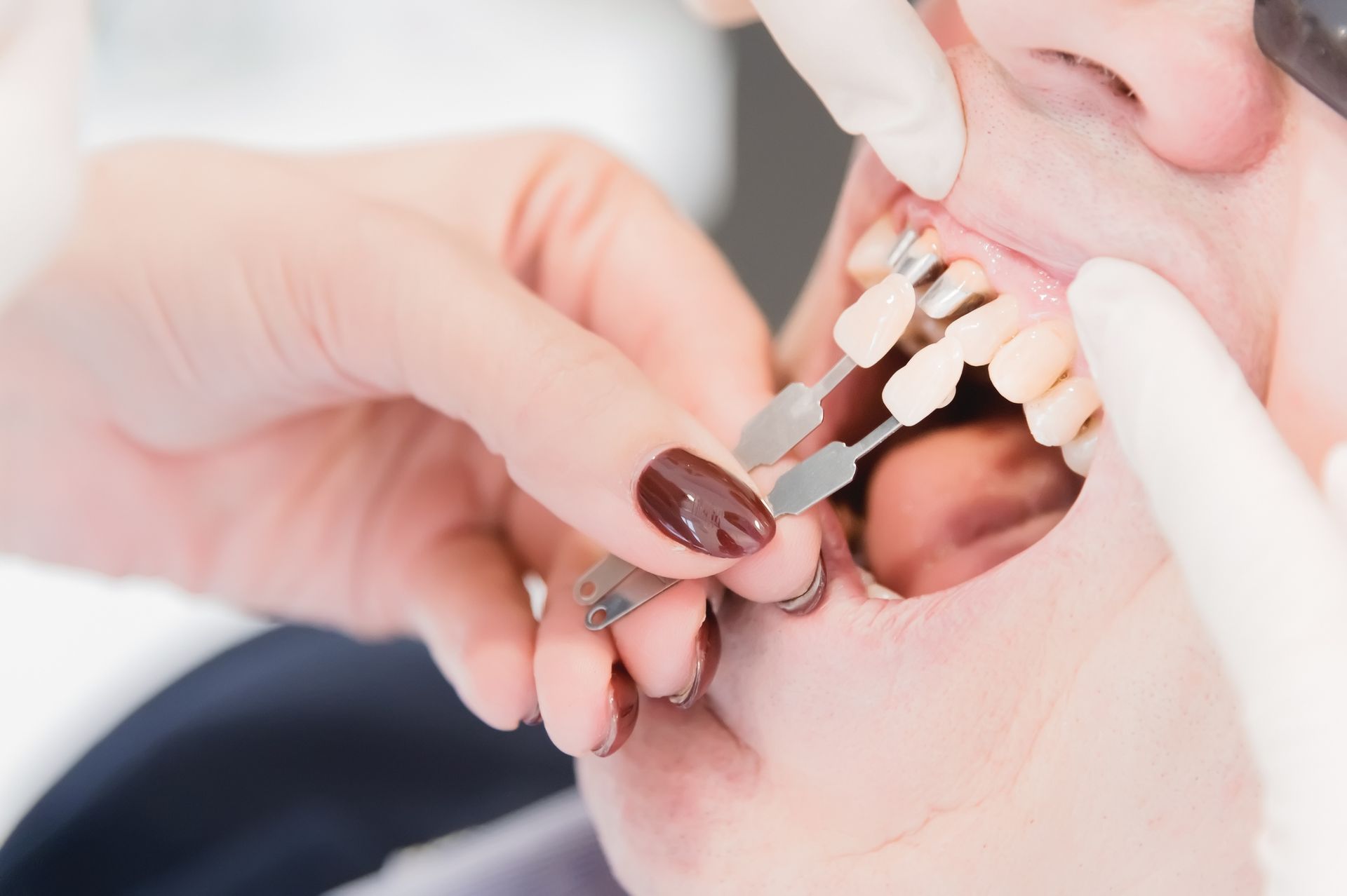 Dentist comparing tooth shade guide to patient's teeth during a procedure. Dentist comparing tooth shade guide to patient's teeth during a procedure.
