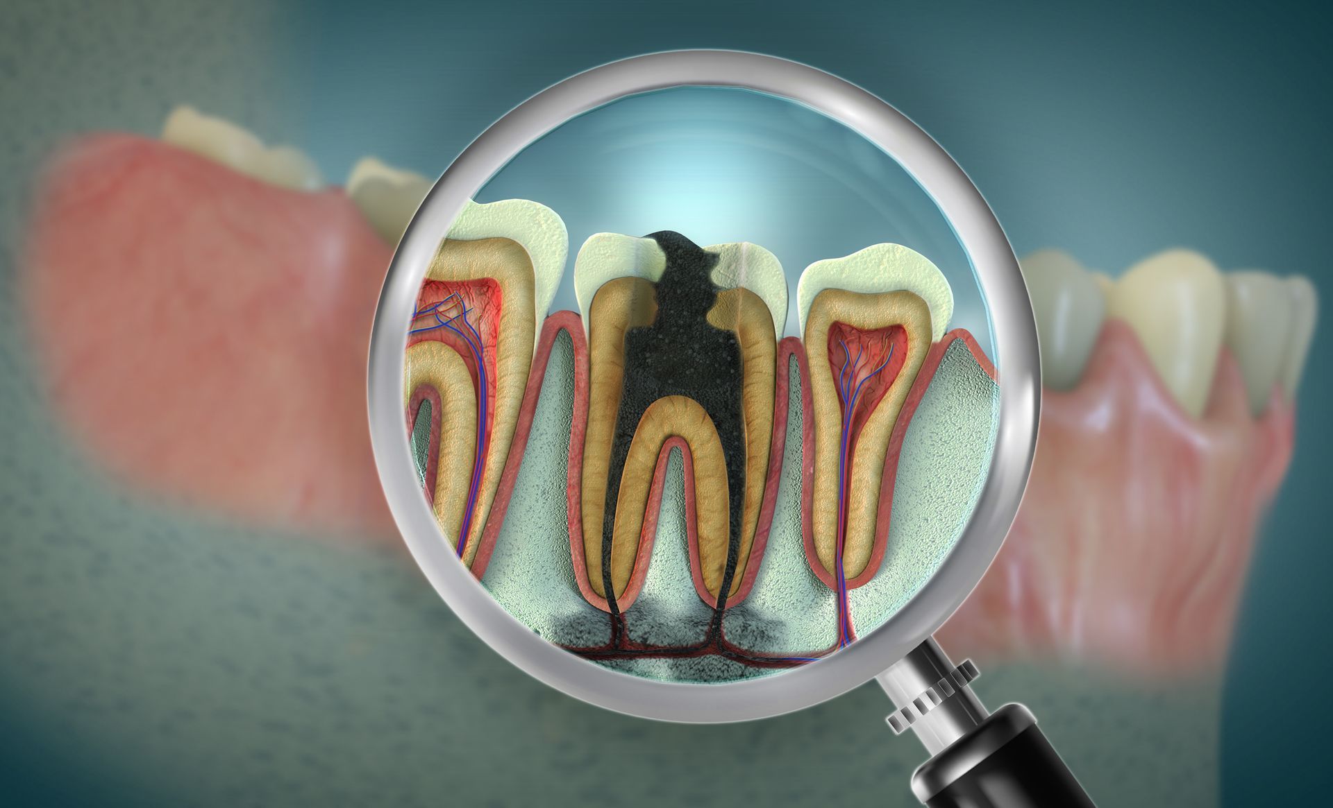 Magnifying glass showing cross-section of a tooth with a deep cavity, in mouth. Magnifying glass showing cross-section of a tooth with a deep cavity, in mouth.