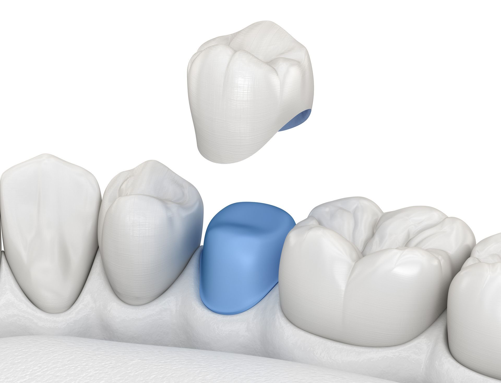 Teeth with blue and green dental treatments in a mouth, with a plastic retractor and rubber dam. Teeth with blue and green dental treatments in a mouth, with a plastic retractor and rubber dam.