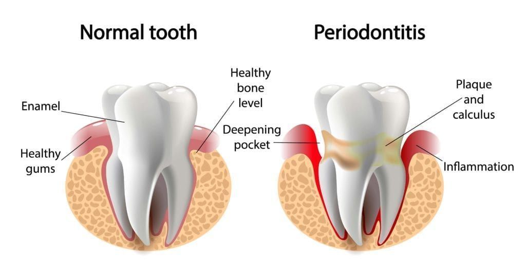 Comparison of a normal tooth versus a tooth with periodontitis; showing healthy gums vs. inflammation, bone loss, and plaque buildup. Comparison of a normal tooth versus a tooth with periodontitis; showing healthy gums vs. inflammation, bone loss, and plaque buildup.
