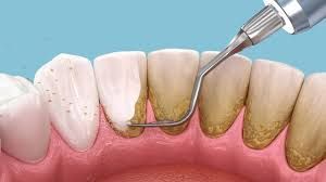 Dental cleaning procedure: A tool removes plaque and tartar from a row of teeth, showing the cleaning process. Dental cleaning procedure: A tool removes plaque and tartar from a row of teeth, showing the cleaning process.