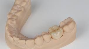 Dental cast with a single tooth crown in place. Beige colored cast with white background. Dental cast with a single tooth crown in place. Beige colored cast with white background.