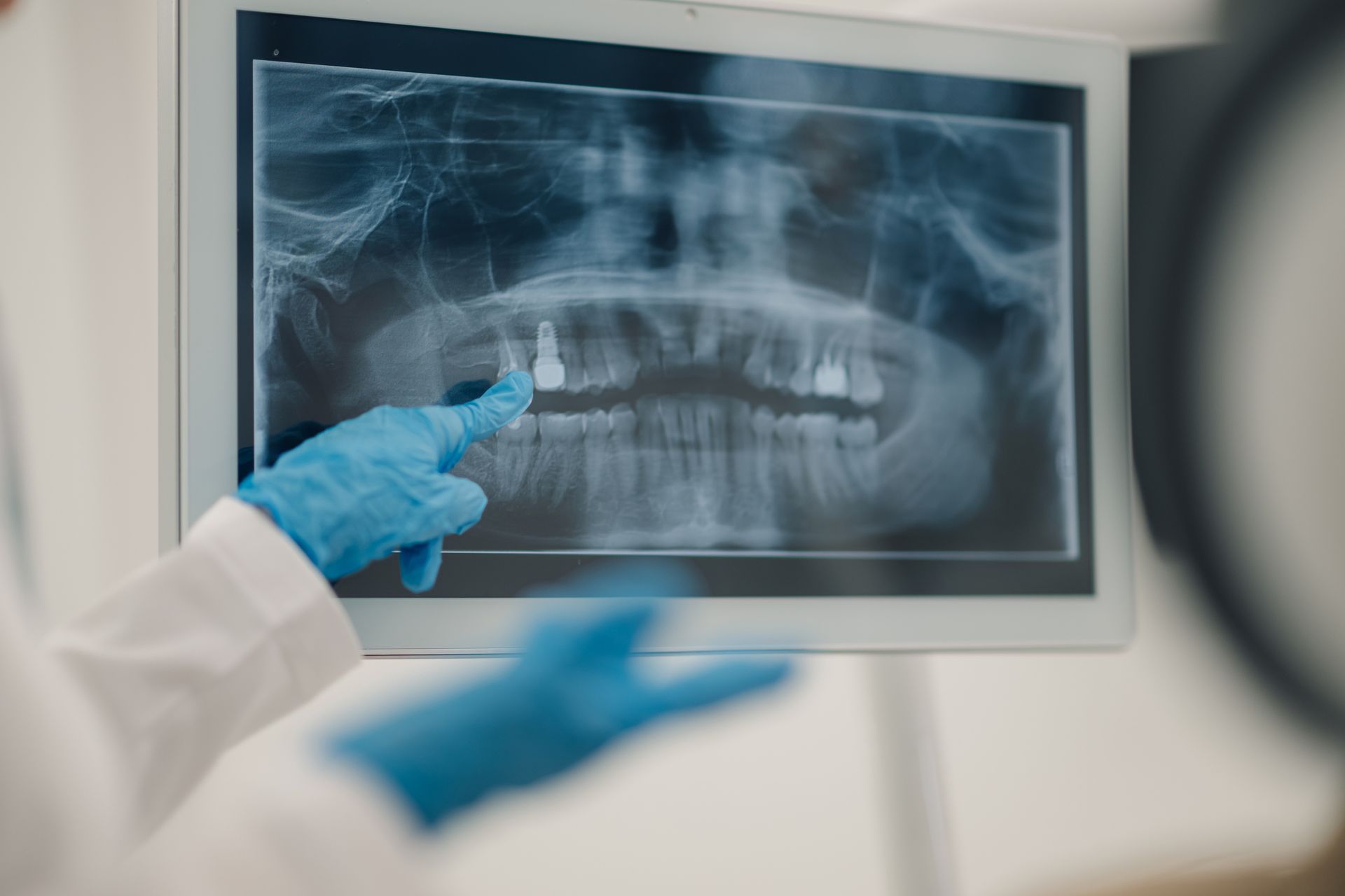 Dental X-ray of teeth on a screen, with gloved hand pointing at implants. Medical setting.