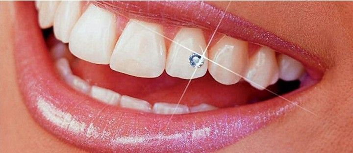 Close-up of a smiling mouth with bright white teeth and a sparkling jewel on one tooth. Shiny, pink lips. Close-up of a smiling mouth with bright white teeth and a sparkling jewel on one tooth. Shiny, pink lips.