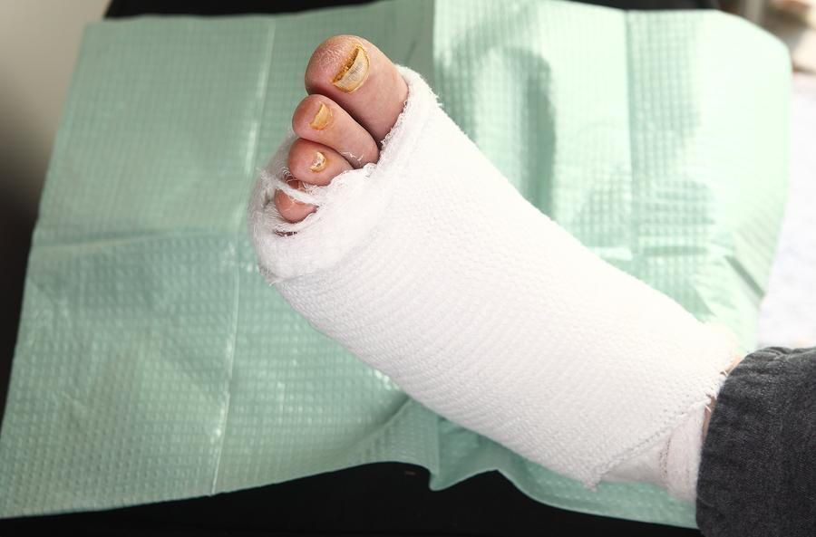 Foot in a white cast, resting on a green medical drape. The toes are visible.