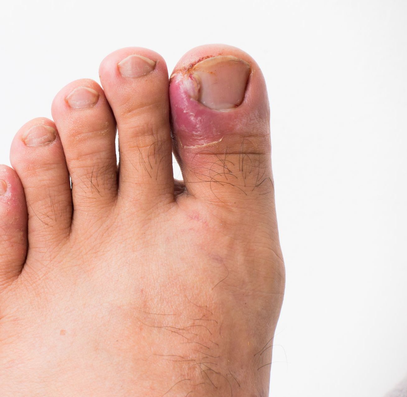 Foot with an infected big toe, red and swollen.