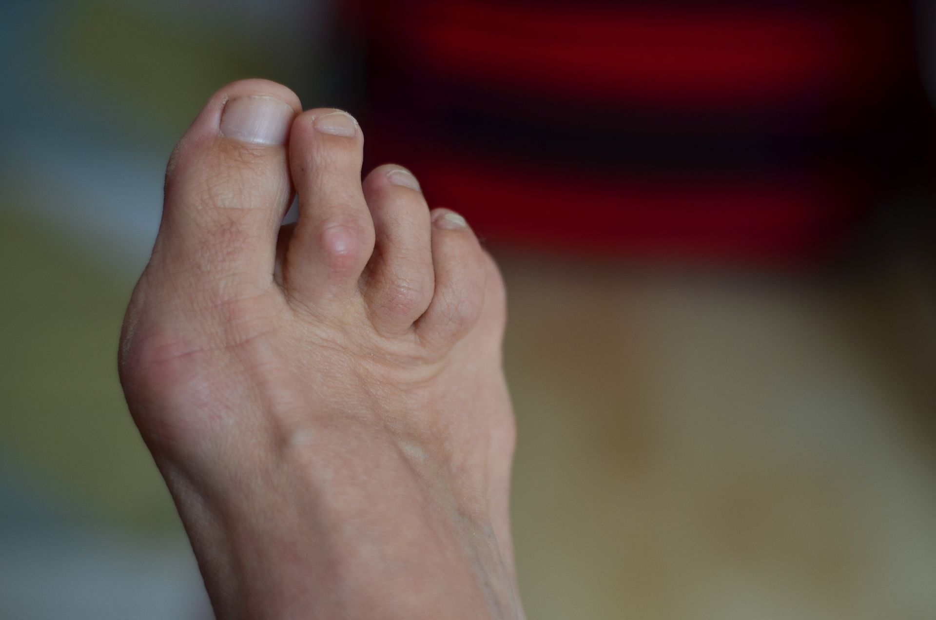 Foot with bunion. Skin-toned, with visible veins. Toes slightly curled.
