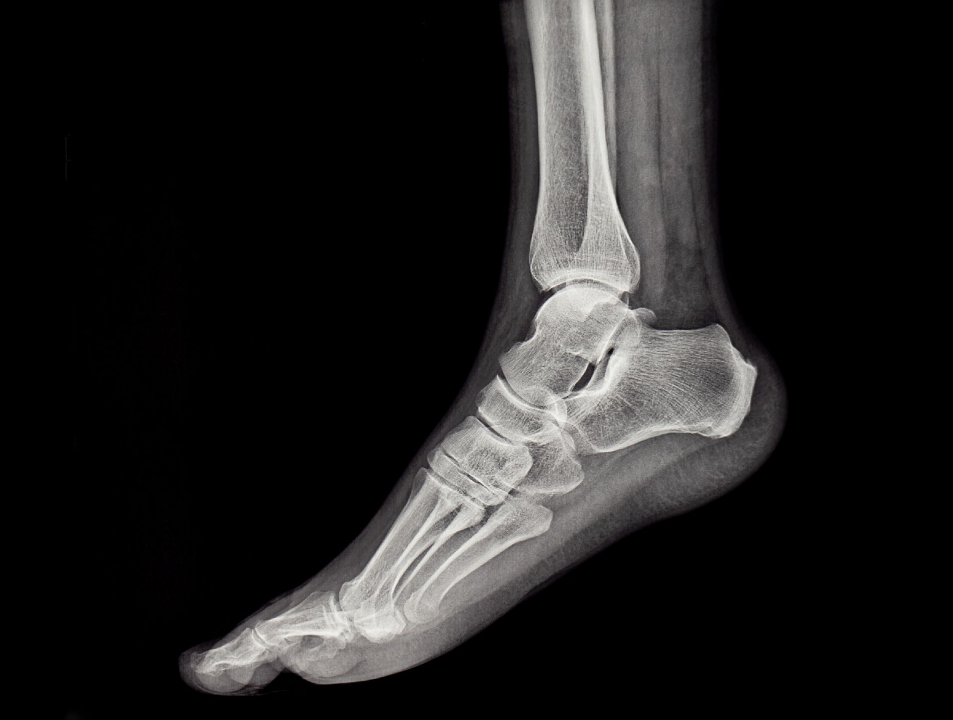 X-ray of a human foot and ankle, showing bones in a side view.