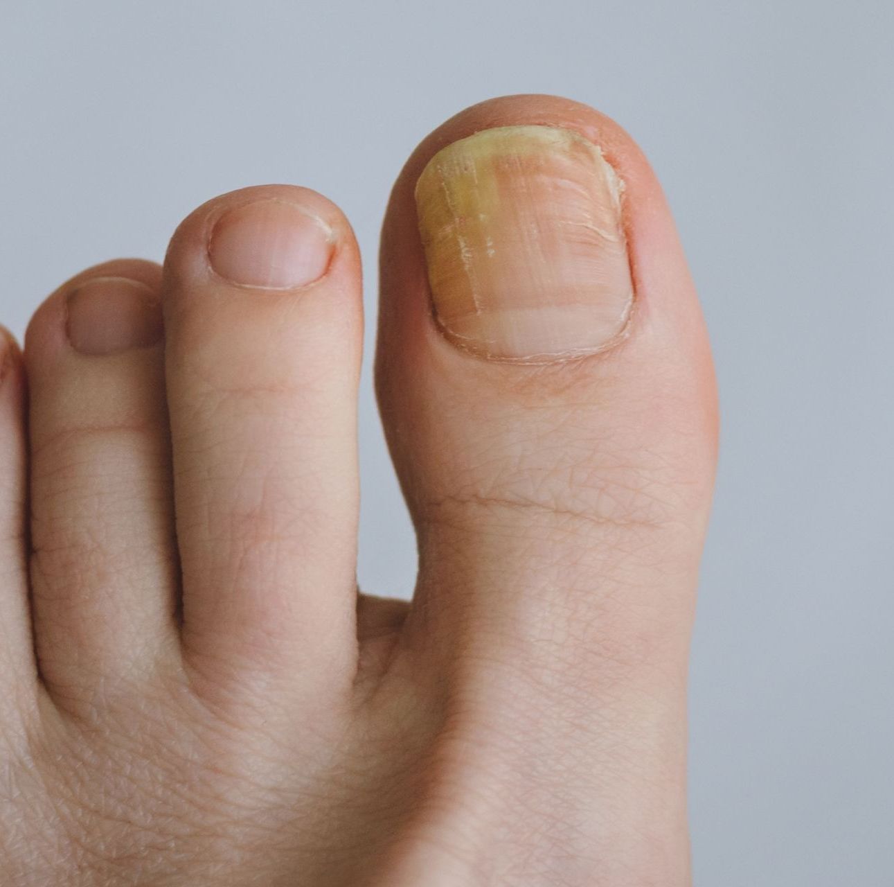 Close-up of a foot with a yellowed, thick toenail. Other nails are healthy.