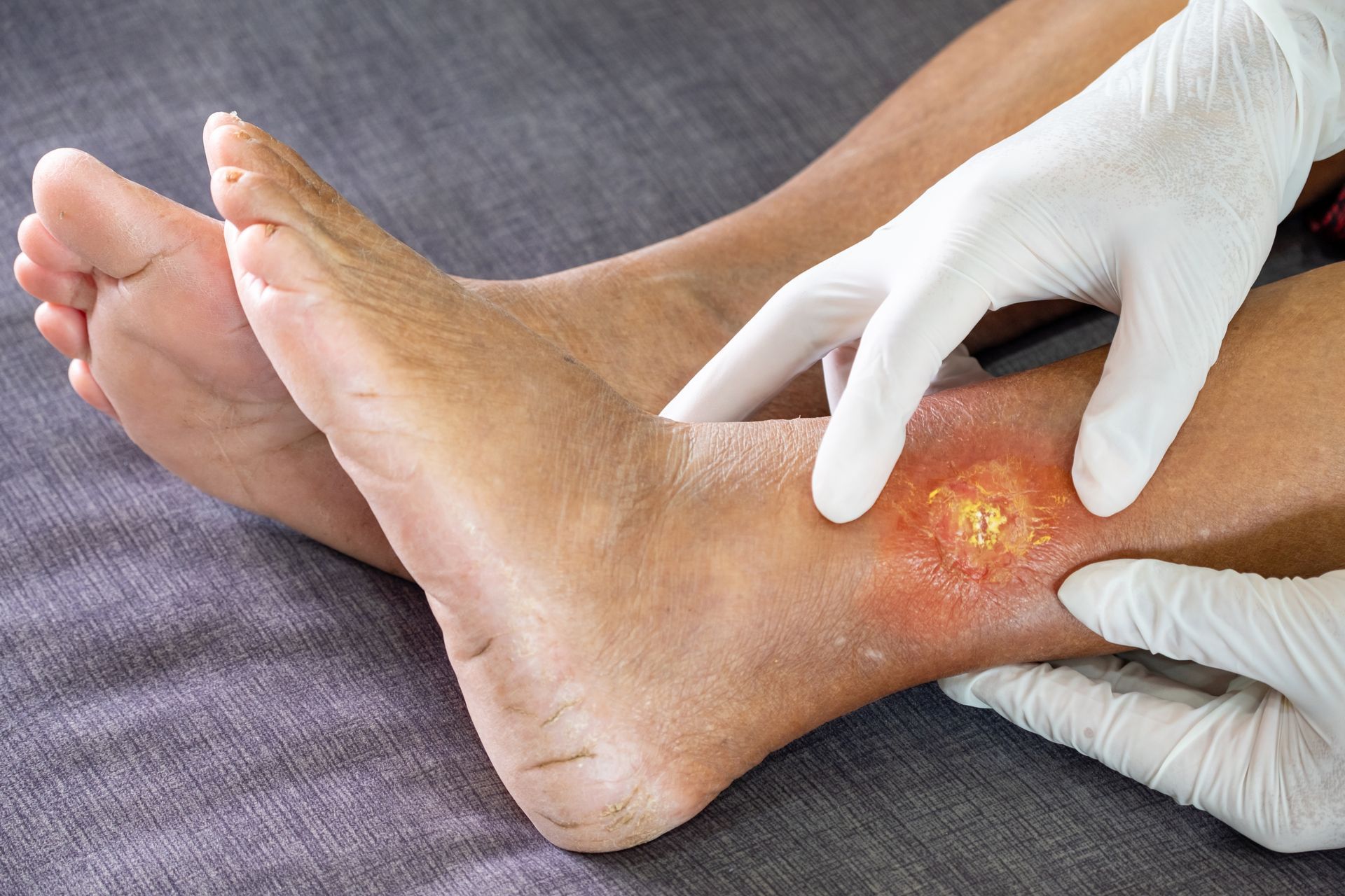 A person's swollen ankle and leg are examined by gloved hands, revealing an open wound surrounded by redness.
