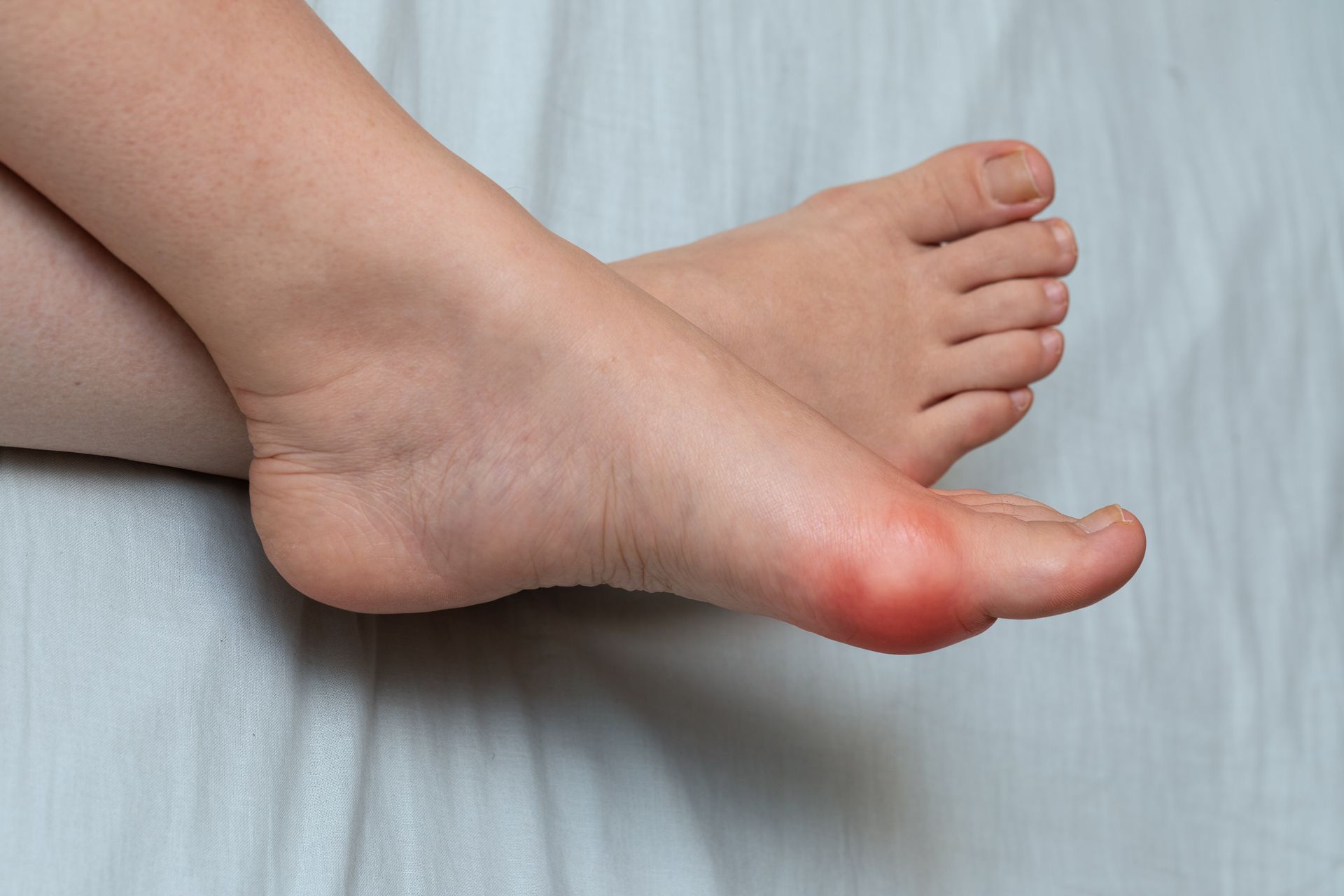 Foot with inflamed, red bunion.