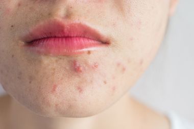 Acne Scars On Woman's Face — New Port Richey, FL — New Image Dermatology