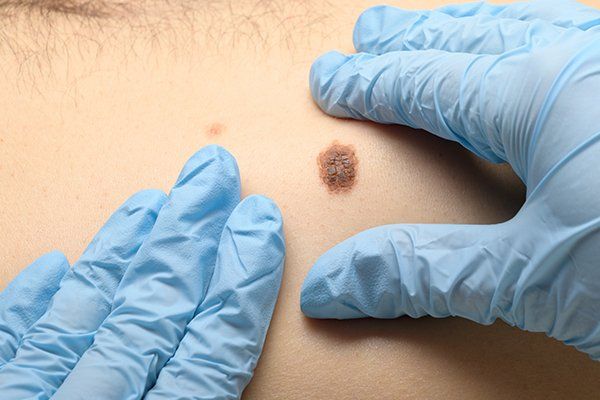 Moles Check-up — New Port Richey, FL — New Image Dermatology