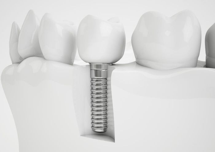 illustrazione di implantologia dentale