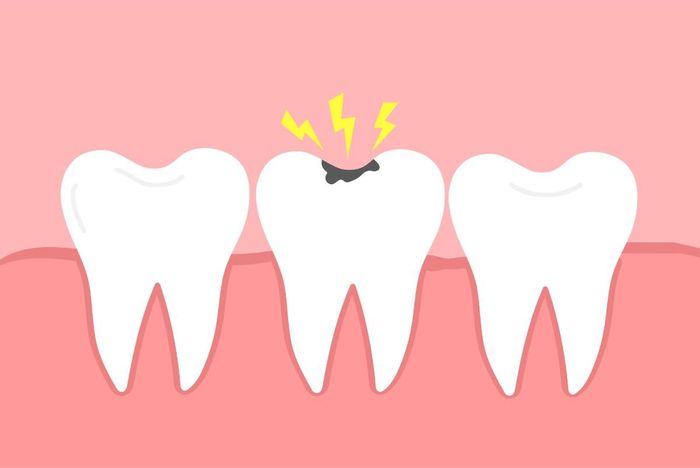 illustrazione dei denti con carie