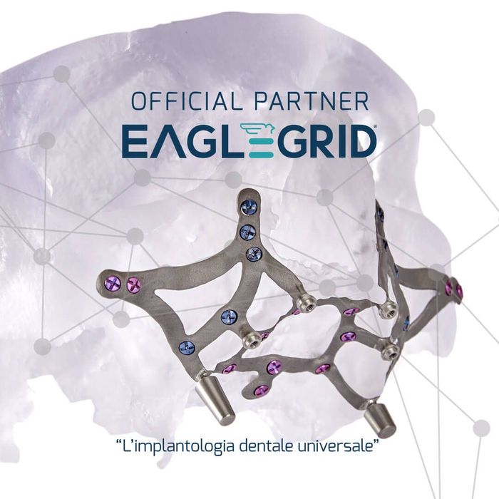 immagine di eagle grid impianti in assenza di osso