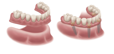 A picture of a denture with screws in it.