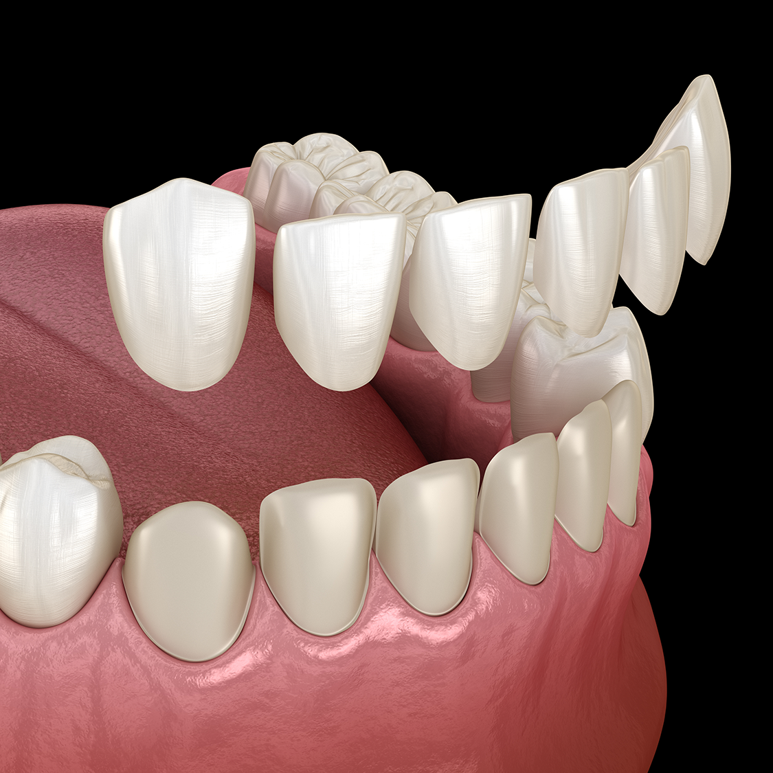 A computer generated image of a person 's teeth with a dental bridge.