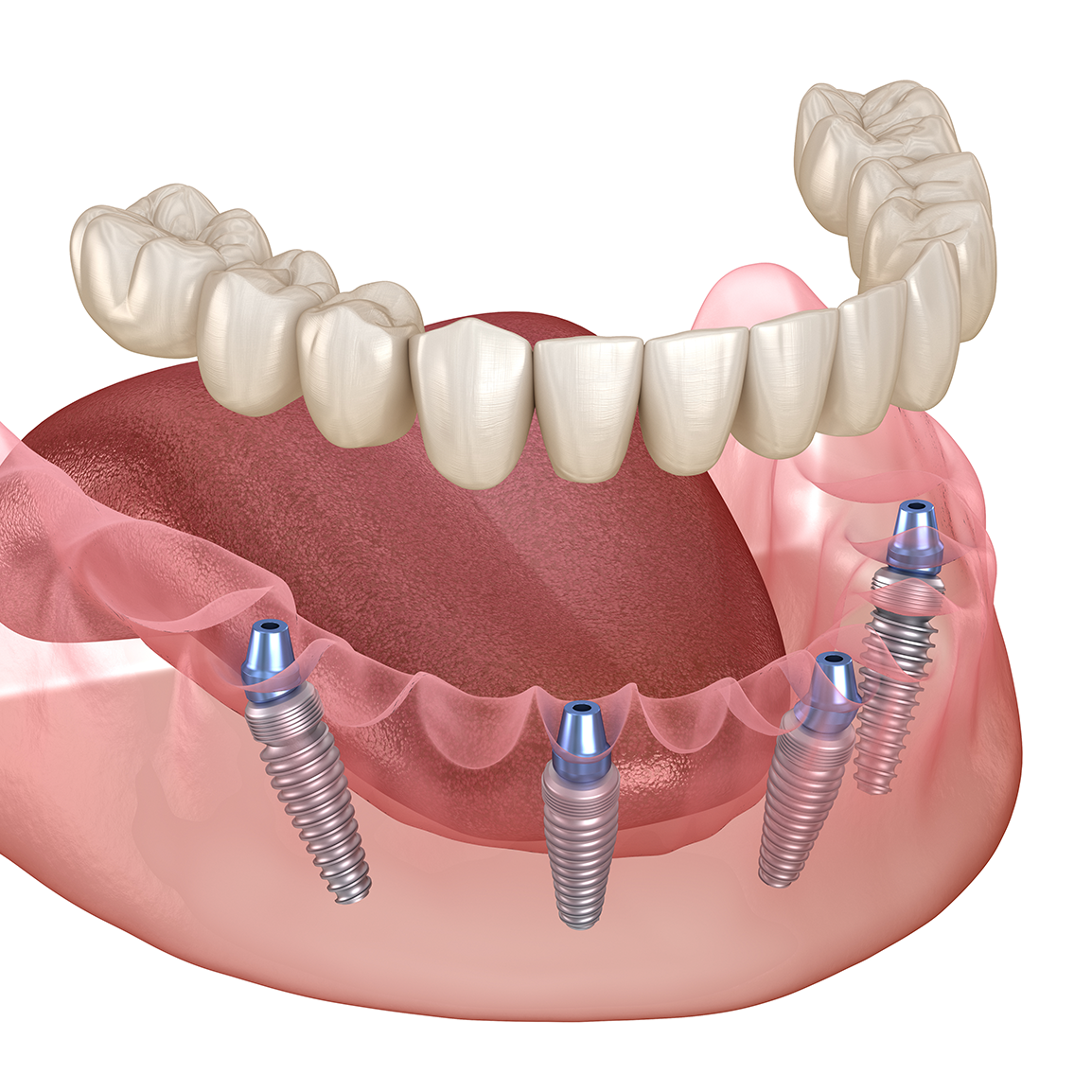 A computer generated image of a denture with dental implants