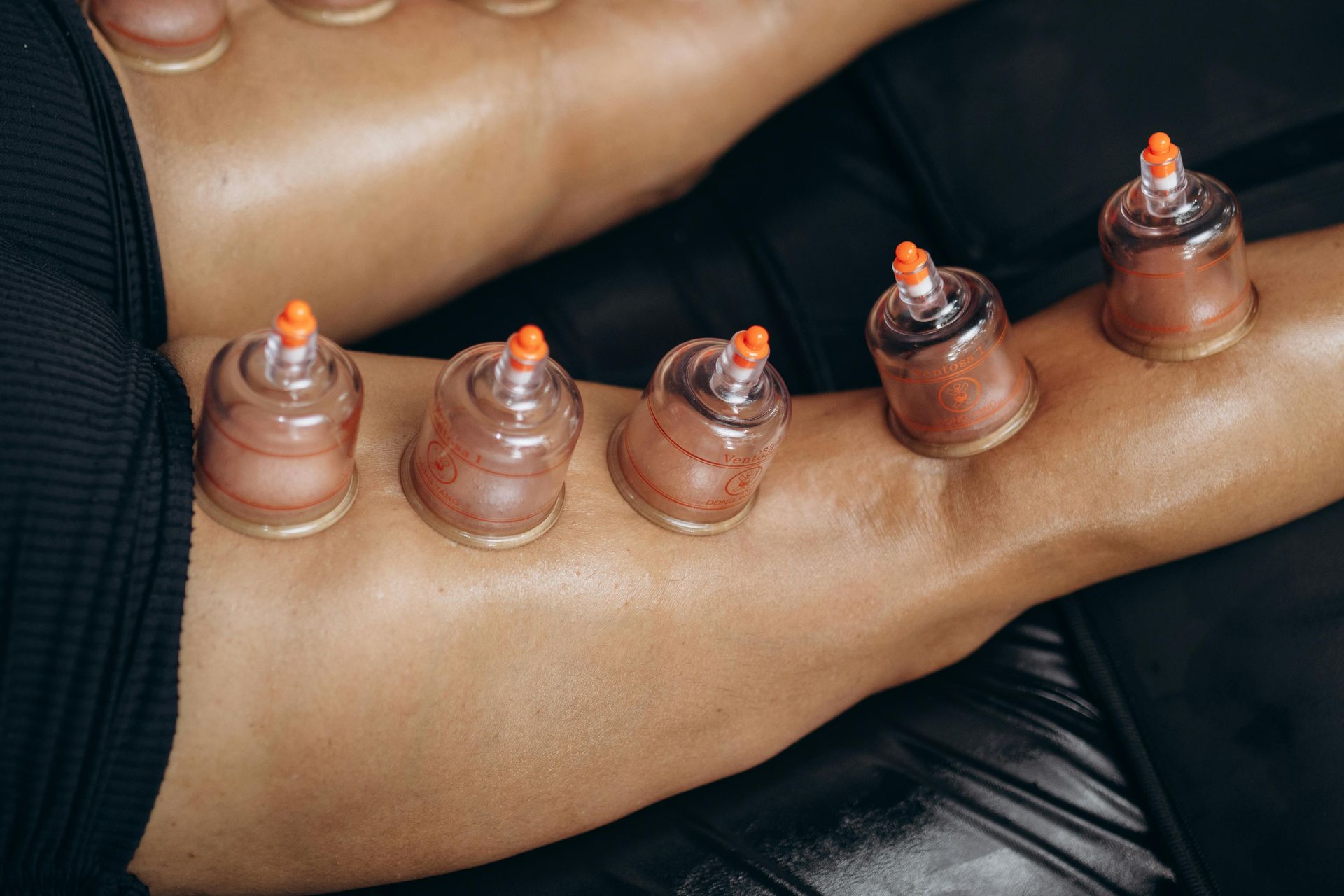 A person is getting cupping treatment on their leg.