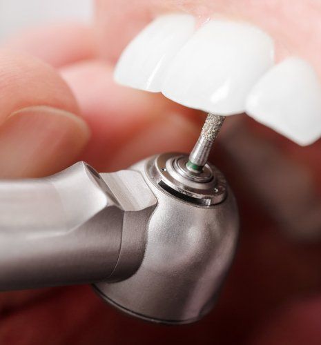 Dental Fillings — Closeup of Teeth Being Drilled by Dentist in Brownsburg, IN