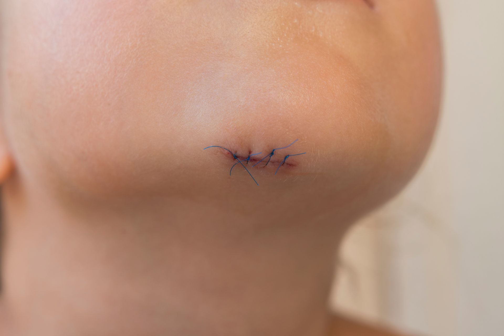 Chin with a small, recent surgical incision closed with stitches.