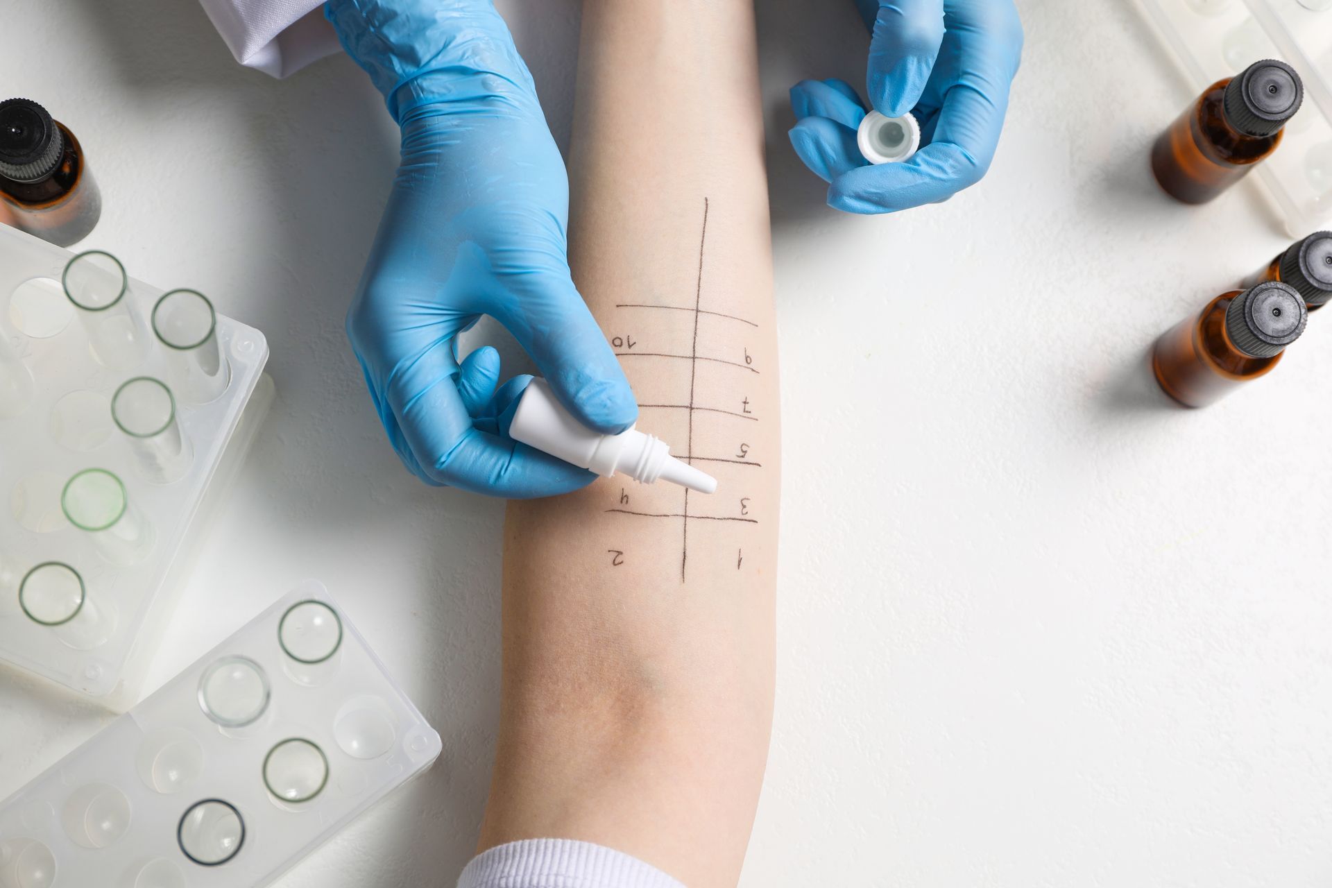 Allergy test being administered on an arm; gloved hands applying liquid to marked skin.