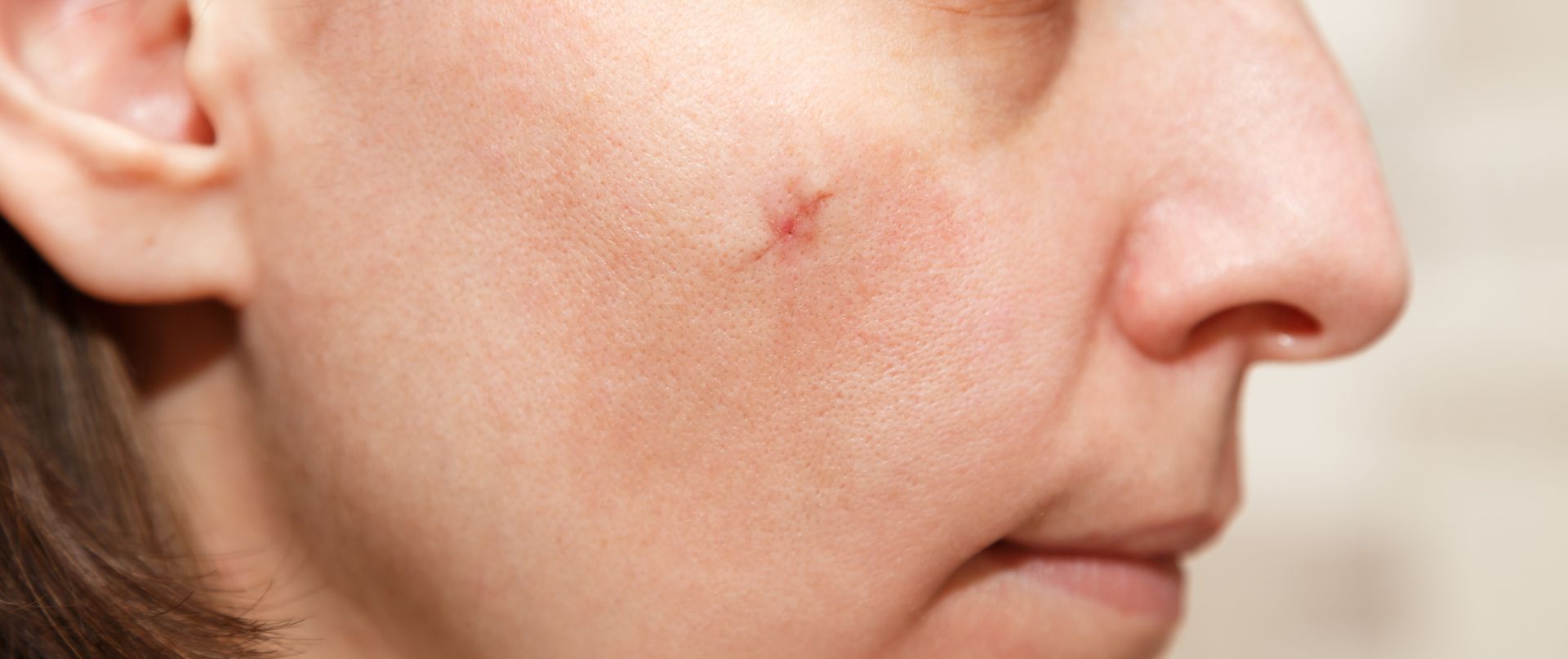 Close-up of a person's face showing a scar on their cheek and their nose.